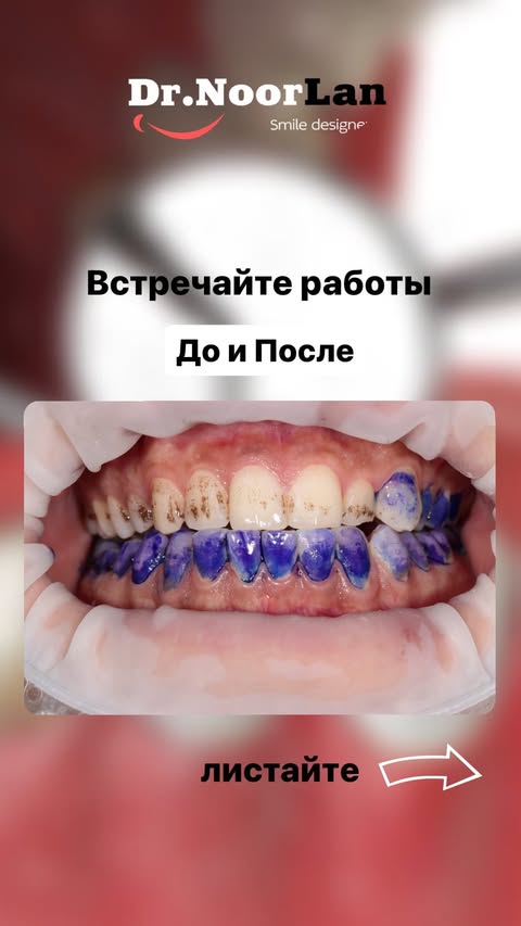 Работы до и после — стоматология Dr.NoorLan