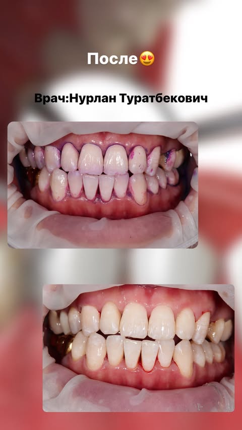 Результат лечения — до и после